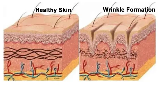 Anti-wrinkle Anti-wrinkle